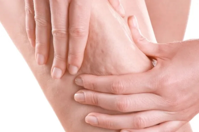 Prof. Dr. Karacalar’dan selülit uyarısı